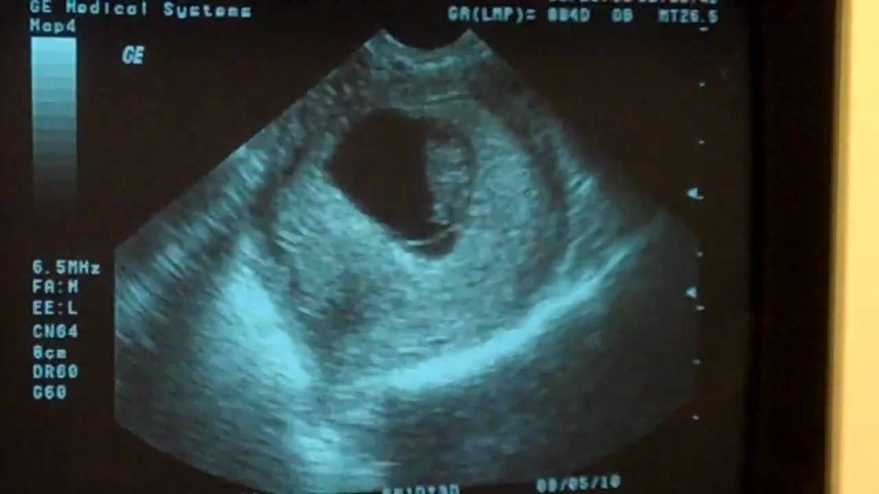 A heartbeat 8 Weeks 1 Day Ultrasound - YouTube