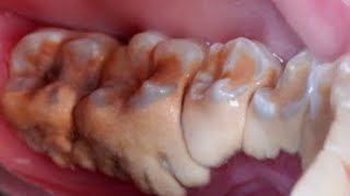 57 Yo. Females Teeth Tartar Removal Scaling Dentist