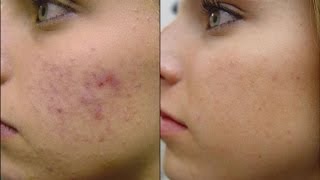 Mascarilla para el Acne y Anti Edad Natural para Todo Tipo de Piel