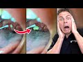 How You Are Removing Tonsil Stones The WRONG Way!