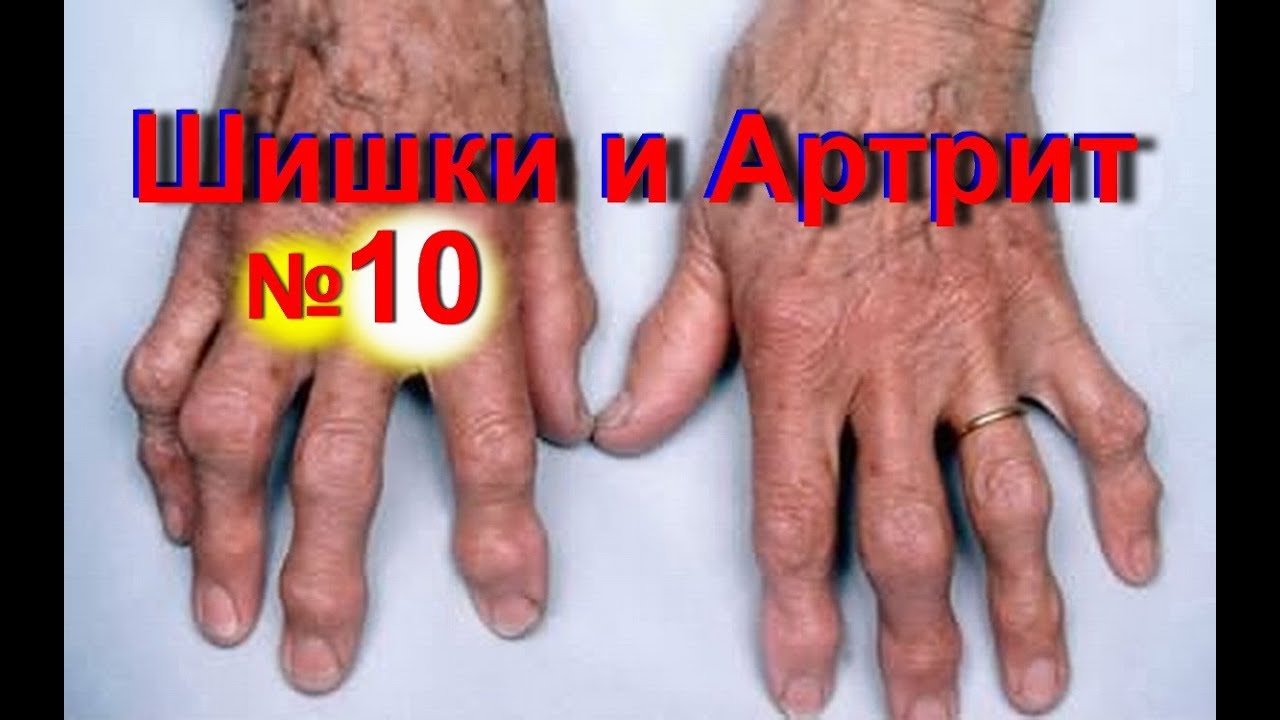 Ревматизм полиартрит народная медицина рецепты лечения болезней