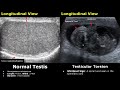 Scrotal Ultrasound Normal Vs Abnormal Image Appearances | Scrotum, Testis, Epididymis USG Scan
