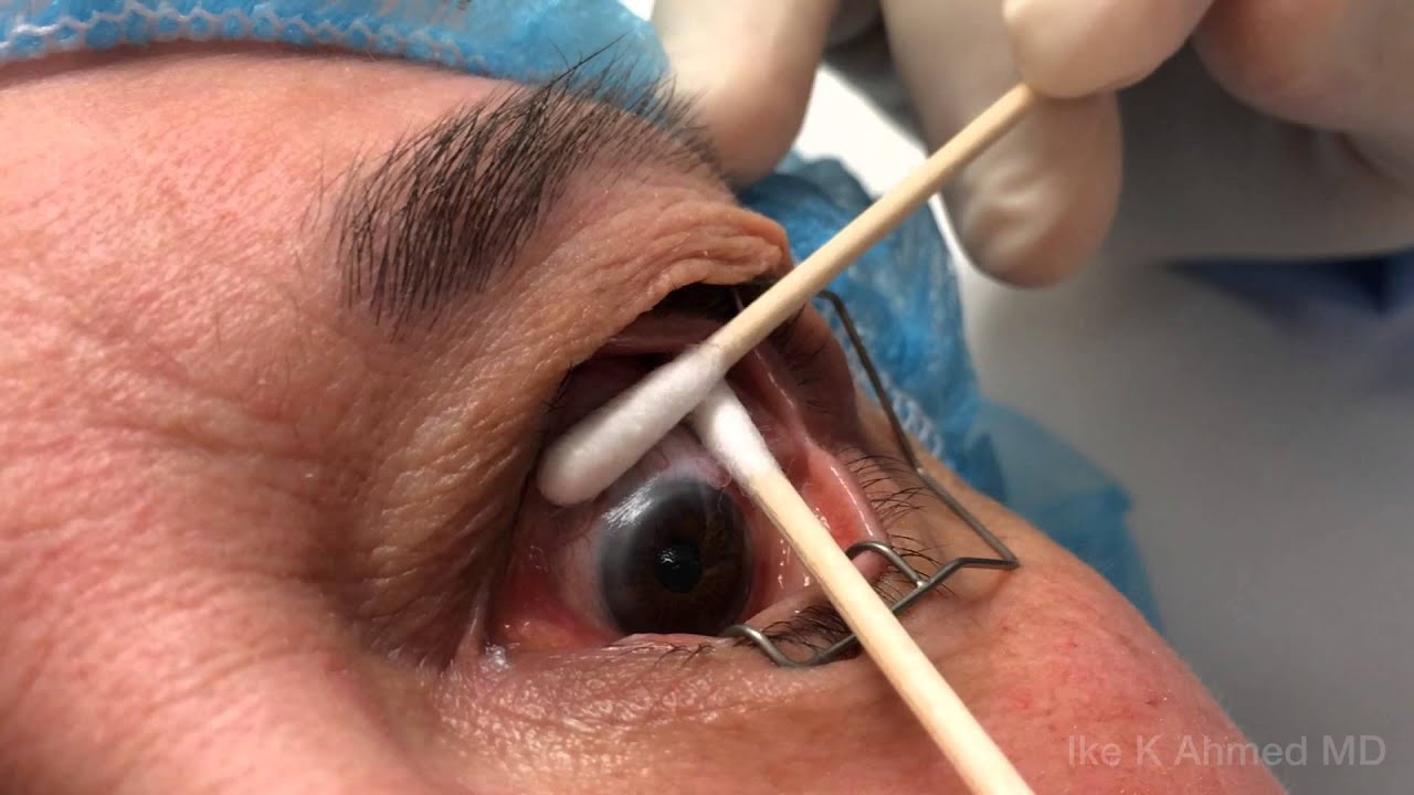 Mitomycin C Injection Prior To Trabeculectomy Glaucoma Surgery You Mitomycin C Injection Prior To Trabeculectomy Glaucoma Surgery