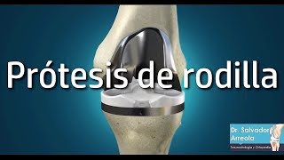 Beneficios de una Prótesis de rodilla