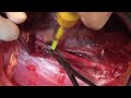kidney