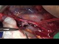 kidney