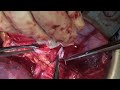 kidney