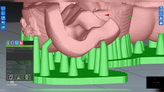 Planmeca Creo® C5 Studio software – Printing a surgical guide