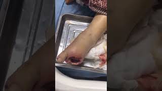 Diabetic Foot 2