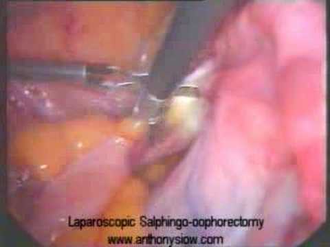robotic hysterectomy with bilateral salpingo oophorectomy