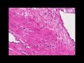 Histopathology Uterus --Leiomyosarcoma