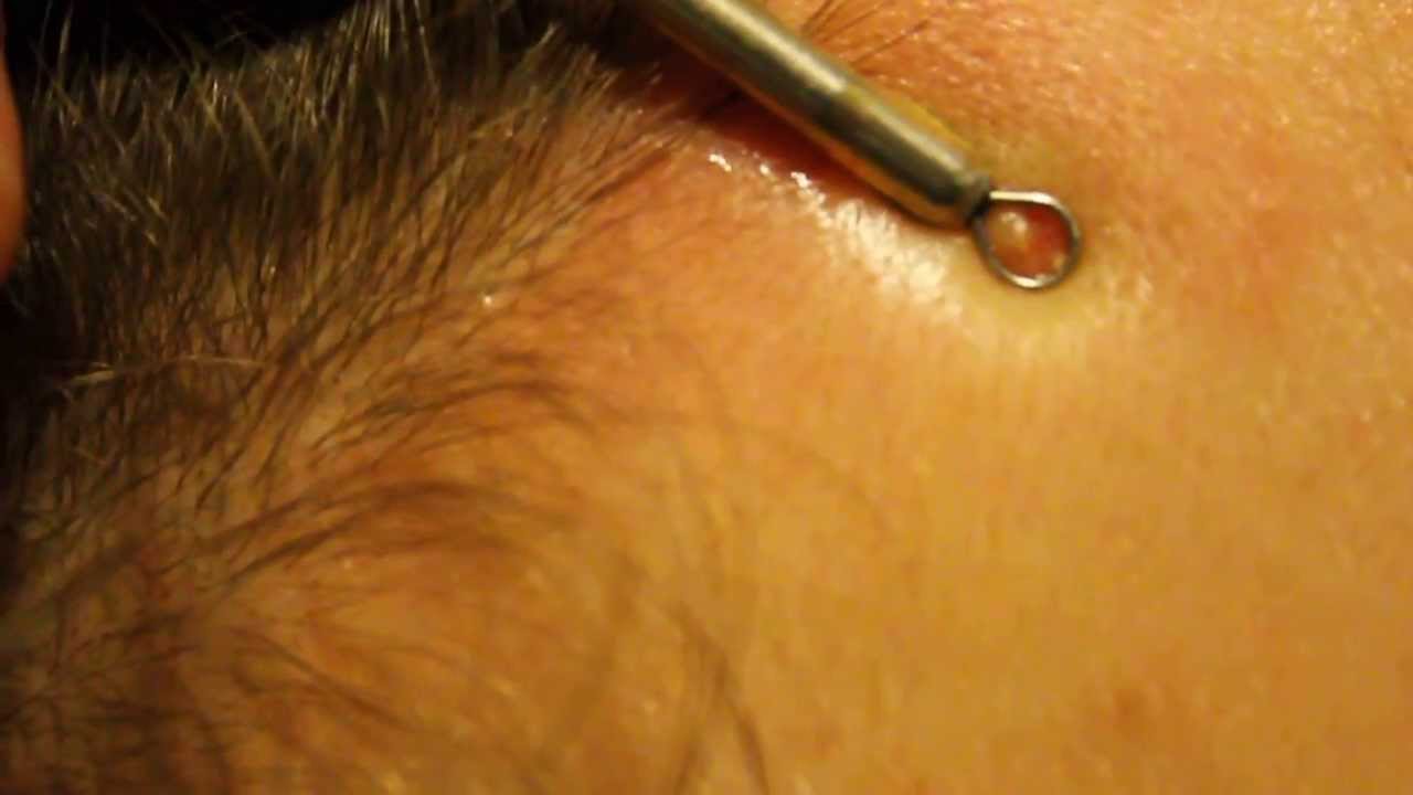 Blackhead extraction - forehead zit - YouTube