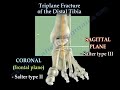 Triplane Fracture Of The Distal Tibia - Everything You Need To Know - Dr. Nabil Ebraheim