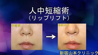 人中短縮術(リップリフト) 山本クリニック
