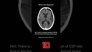 Brain Ct Question 20