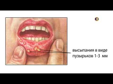 Отек горла и десен что это такое 131