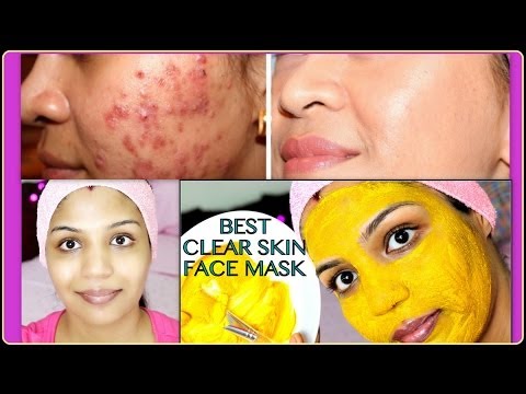 Get Acne Fast  for  Get face Acne mask Treatment How best Best to Rid diy pimples  Naturally, Of