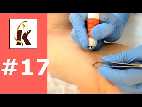 Электрокоагуляция- Как убрать родинки, бородавки, папилломы, рубиновые точки, сосуды (купероз)# 17 Электрокоагуляция- Как убрать родинки, бородавки, папилломы, рубиновые точки, сосуды (купероз)# 17