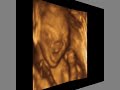 ultrasound 3d 4d