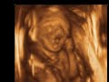 ultrasound 3d 4d