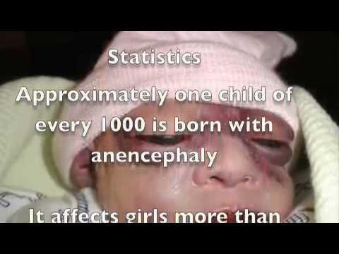 ANENCEPHALY Facts, information, pictures | Encyclopedia.com articles ...