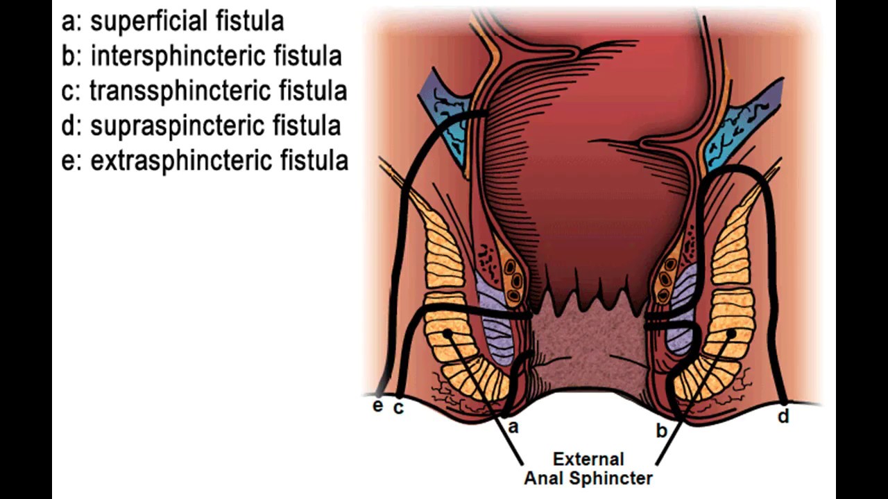 Anus fistula in painful repertory