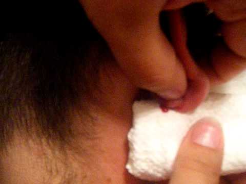 Lancing A Cyst