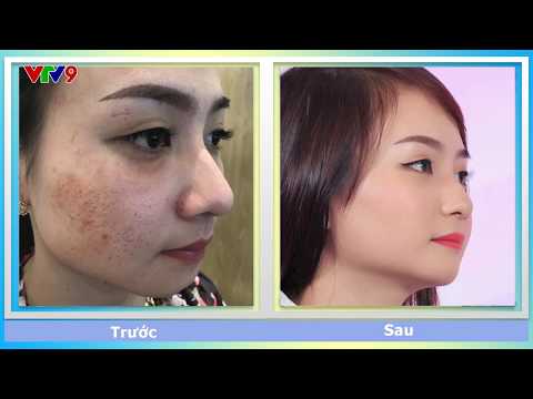 Sai lầm khi trị nám da bằng Laser Co2 Fractional-câu chuyện thật của Tuyết Hồng