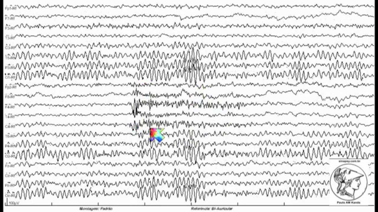 EEG normal comentado. EEG15. YouTube