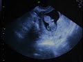 Ultrasound 11 weeks 2D and 4D sonogram