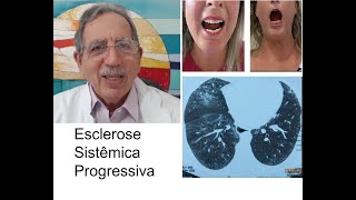 M.B. - Esclerose Sistêmica Progressiva