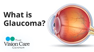 Dr. Weyer Explains What Is Glaucoma?