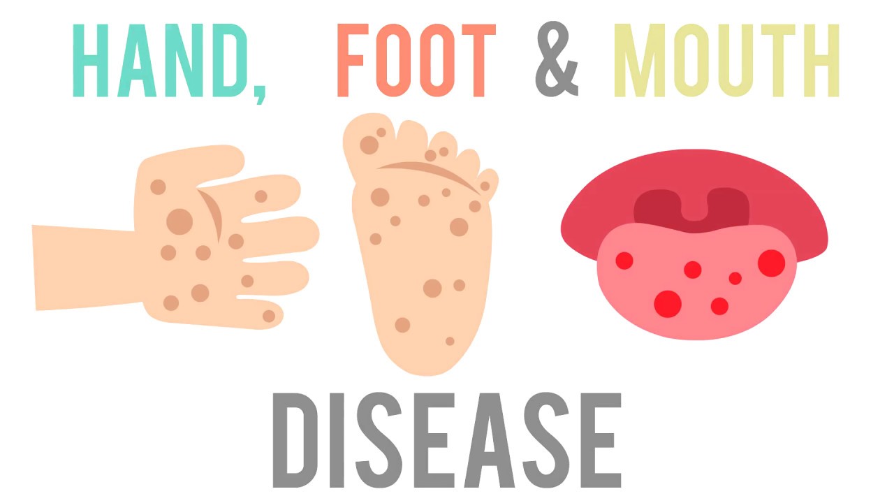 Adult foot and mouth disease