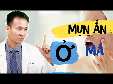 Mụn ẨN ở má - 6 NGUYÊN NHÂN đơn giản hay mắc phải trong SKINCARE ROUTINES | Dr Hiếu