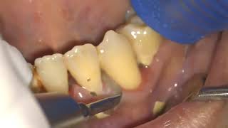 Diş taşı temizliği nasıl yapılır İzle ? Diş taşı temizliği dişe zarar verir mi?
