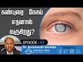 கண்புரை நோய் எதனால் வருகிறது? | what causes cataract? | Dr Arulmozhi Varman, Uma Eye Clinic, EPI 03