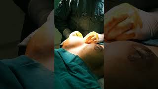 Breast Implant Reels