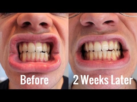  Bright Smile Cost You? Savings Experiment. Teeth whitening cost us