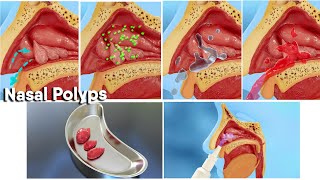 Nasal polyps treatment and surgery! 3d medical animation|Dandelion Team #nasalpo