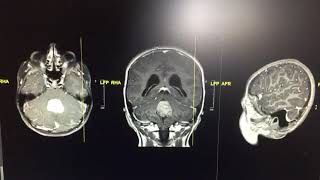 Beyin tümörü tomografi mr görüntüsü