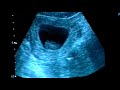 10 week ultrasound