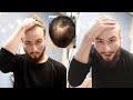 BALDING AT 19 - Dealing With Going Bald Young And Shaving My Head