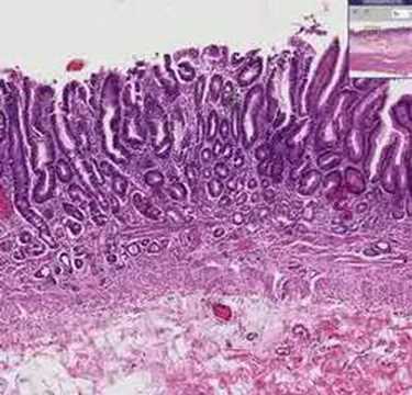 cancer abdominal en niƱos