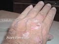 soigner le psoriasis des mains