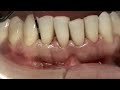 FLAP TECHNIQUE FOR POCKET ( PERIODONTITIS) THERAPY