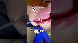 Pop It Dental Abscess