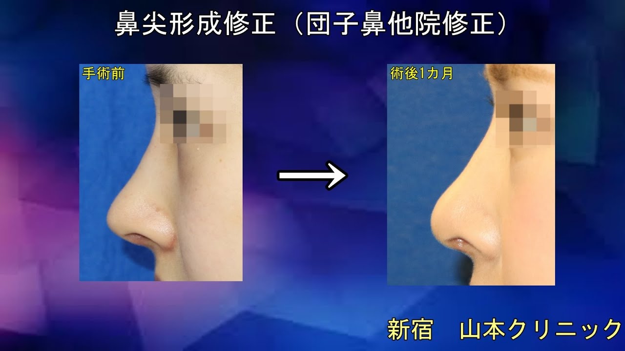 【鼻の修正手術】韓国で受けた手術で不自然に高くなった鼻の他院修正