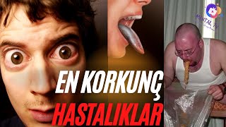 Dünyanın En Korkunç Hastalıkları The Worlds Scariest Diseases