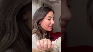 Tuğba Eroğlu Alerji