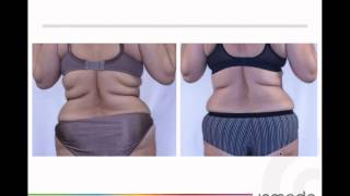 Fat Reduction and Skin Tightening – BodyFX Technology